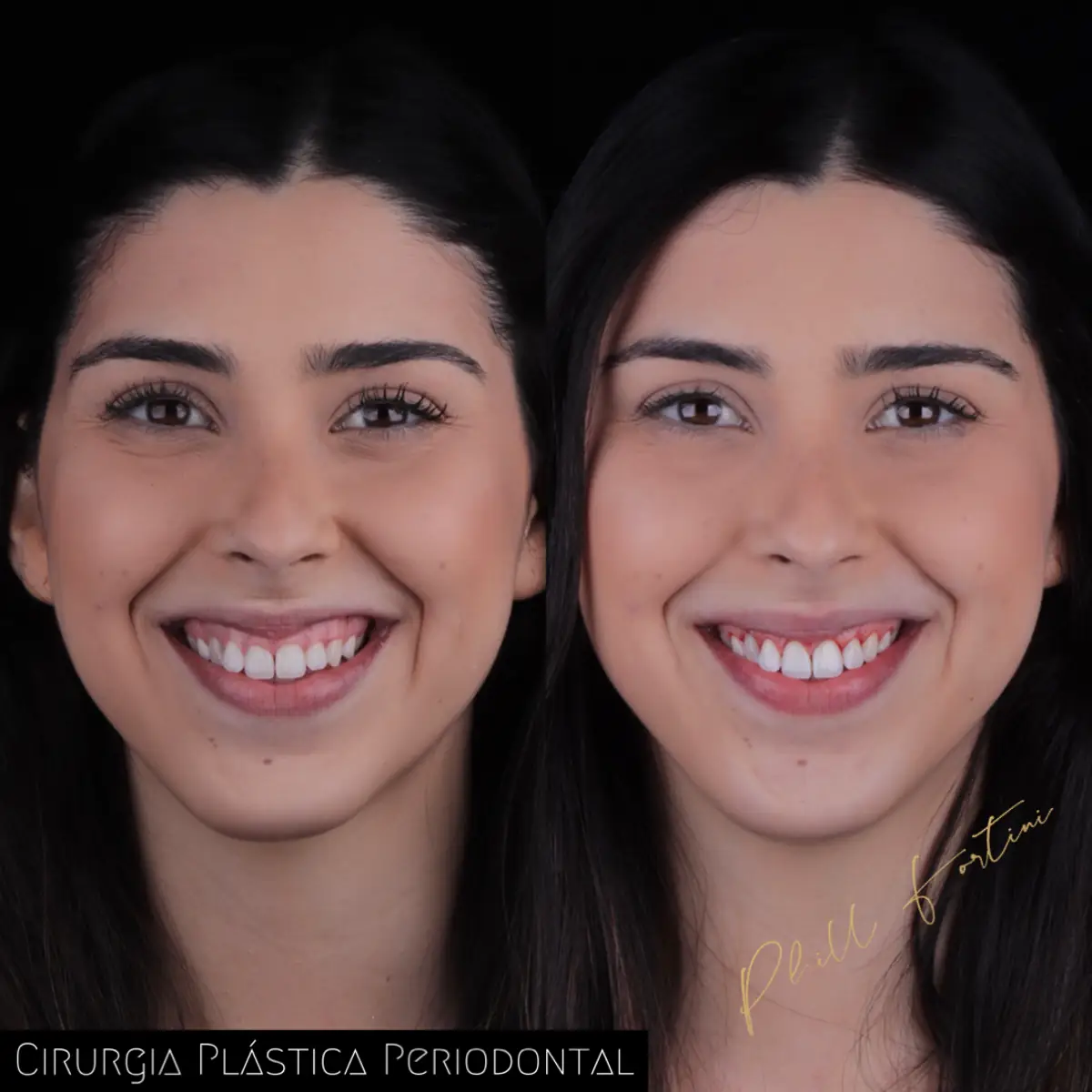 Caso 4 — reabilitação estética