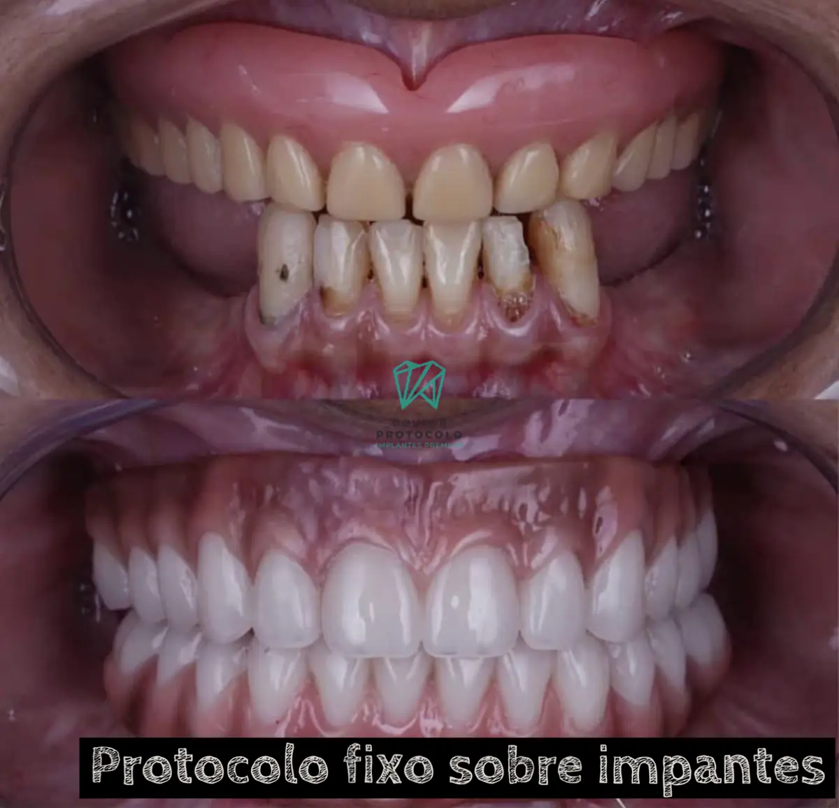 Caso 8 — reanatomização